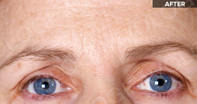 After: Forehead & eye area (frontal): before vs after (labels are burned into Avologi's images).