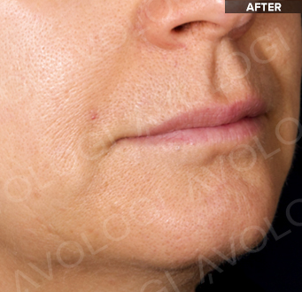 After: Lower face profile, nasolabial area: before vs after (labels are burned into Avologi's images).