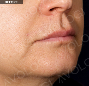 Before: Lower face profile, nasolabial area: before vs after (labels are burned into Avologi's images).