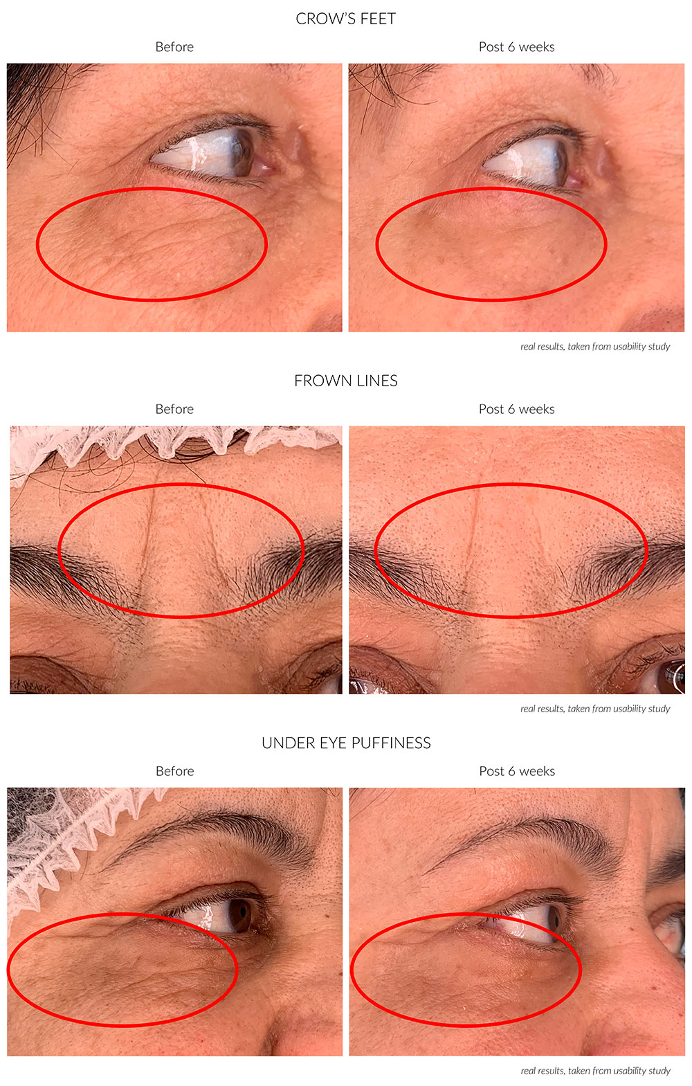Composite published by Avologi: crow's feet, frown lines and under-eye puffiness, 'Before' vs 'Post 6 weeks' (labels and note 'real results, taken from usability study' are Avologi's).