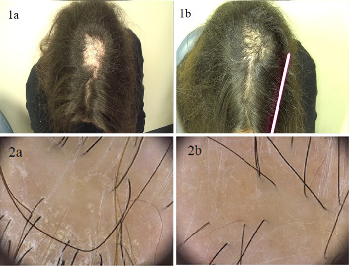 Lichen planopilaris: scalp before and after 18 months of LLLT (hair regrowth); trichoscopy before and after 4 months.