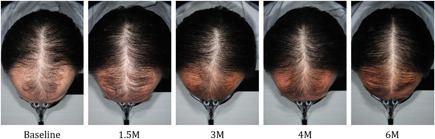 Scalp of one subject at baseline, 1.5, 3, 4 and 6 months.