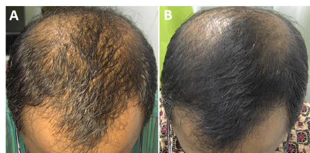 Androgenetic alopecia, male patient: scalp before (A) and after 14 sessions (B), 4-month follow-up.