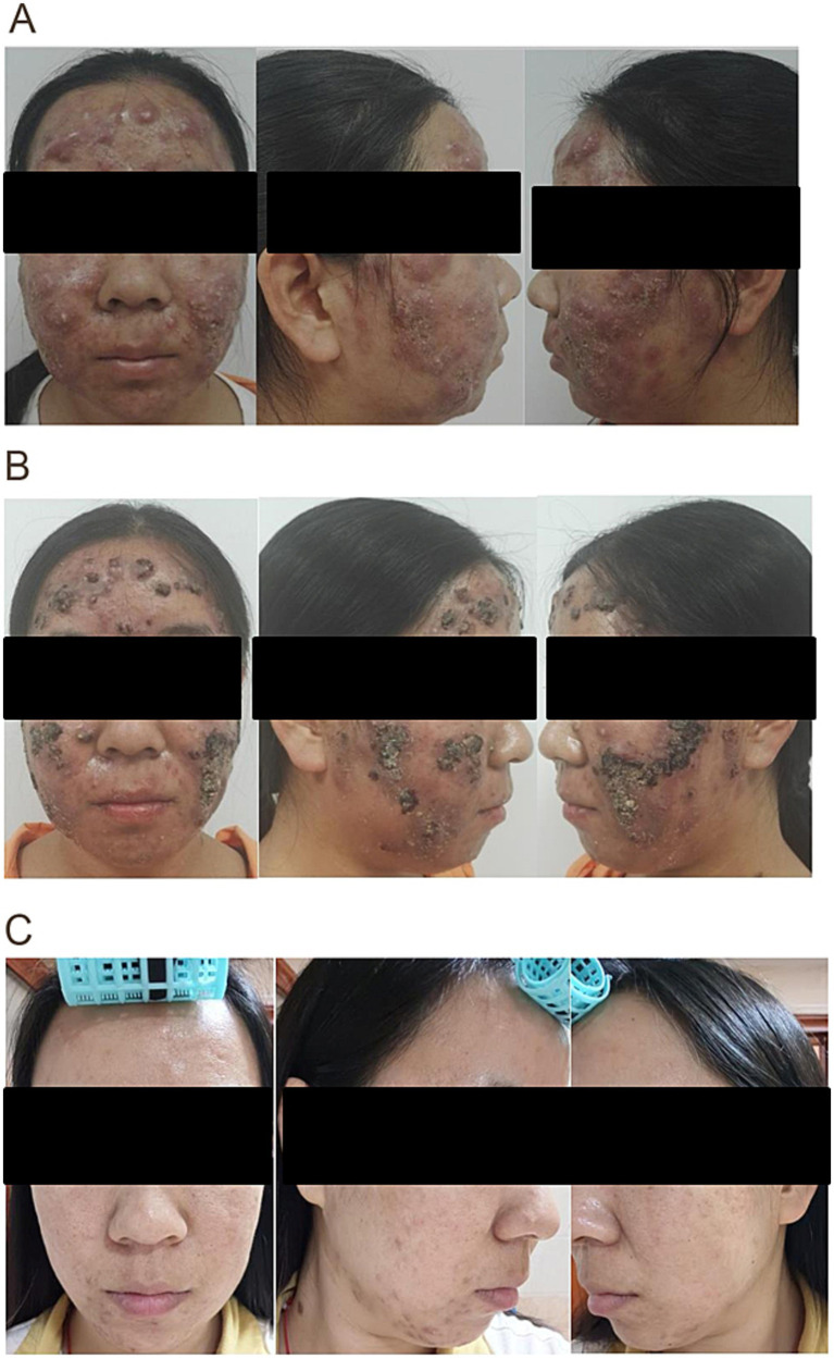 Severe acne conglobata in a 19-year-old: baseline (A), after 1 week (B) and at 8 weeks (C). Eyes masked by the authors.