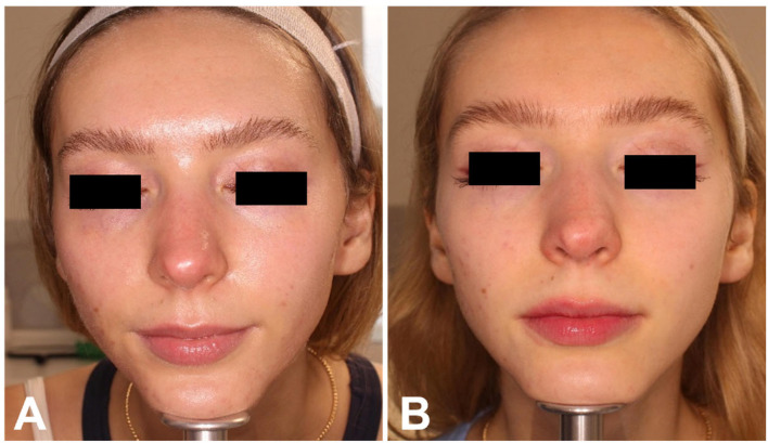 Active facial acne, female patient from the laser-only group: frontal and both profiles, before (A, C, E) and 3 months after the last session (B, D, F). Published as two image files; shown together, unaltered.