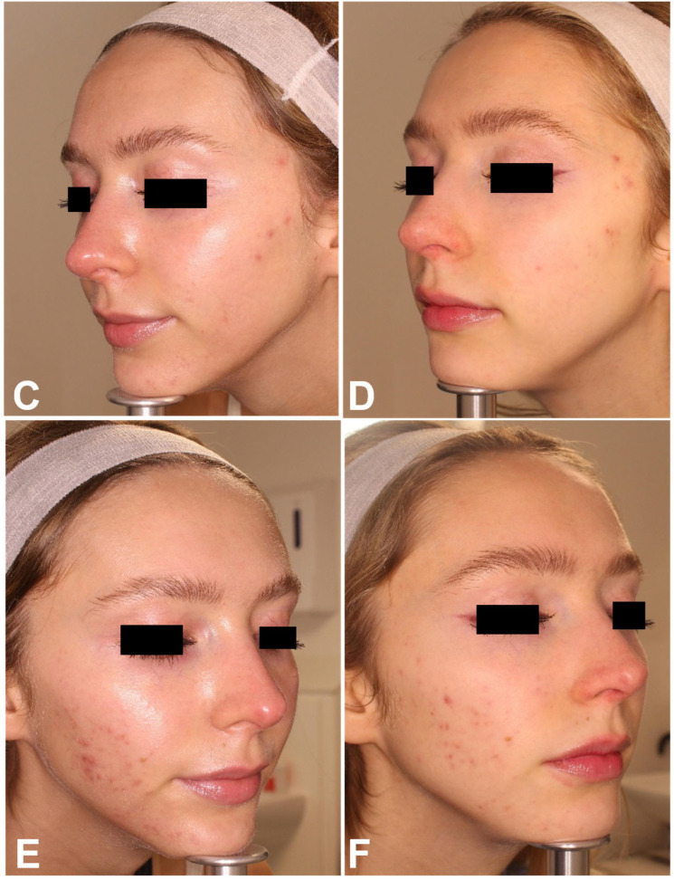 Active facial acne, female patient from the laser-only group: frontal and both profiles, before (A, C, E) and 3 months after the last session (B, D, F). Published as two image files; shown together, unaltered.
