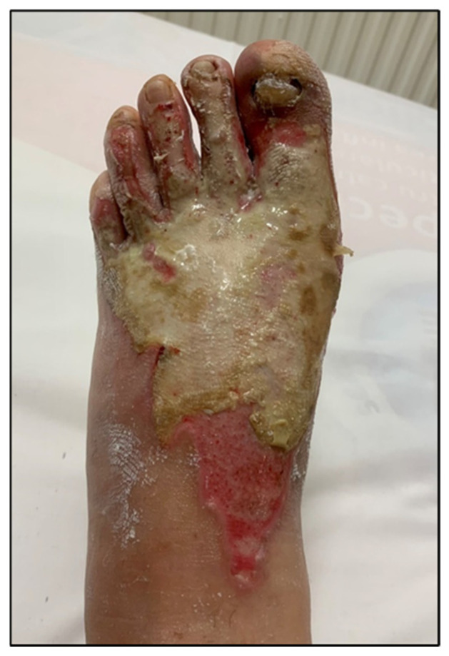 Before: Post-burn lesion, top of the foot: before and after 10 sessions (Figures 3 & 4).