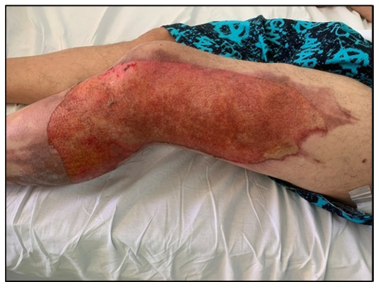 Before: Post-burn lesion, lateral lower limb: before and after 10 sessions (Figures 5 & 6).