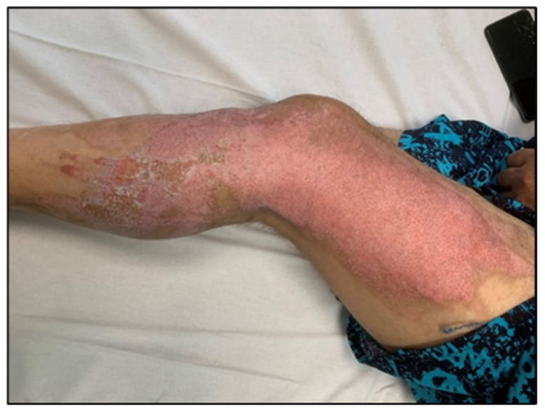 After: Post-burn lesion, lateral lower limb: before and after 10 sessions (Figures 5 & 6).