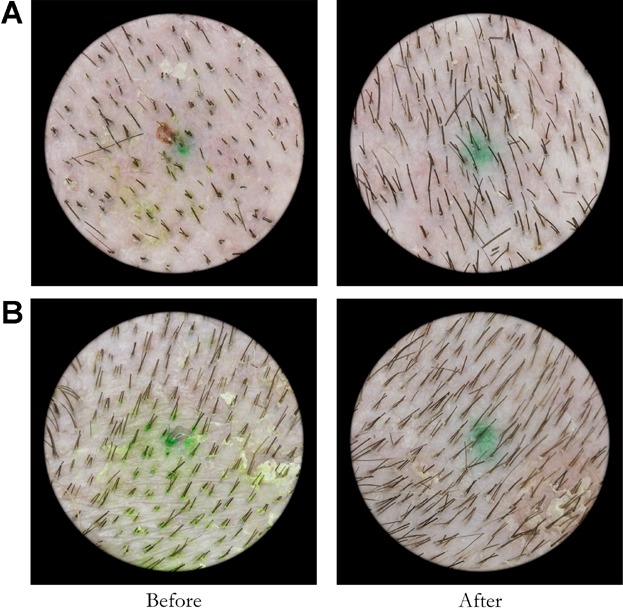 Active-treatment group: scalp close-ups before and after (hair counts 153 to 221 and 108 to 209).
